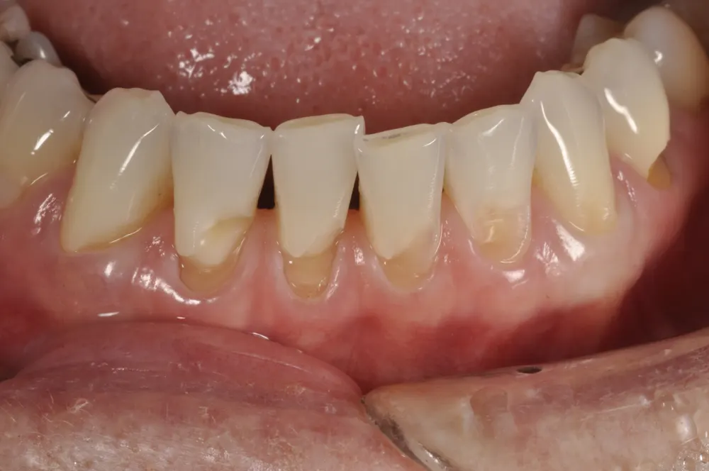 Frontal view of the mandibular incisors, with gingival recession, cervical loss of structure, and flat incisal edges.