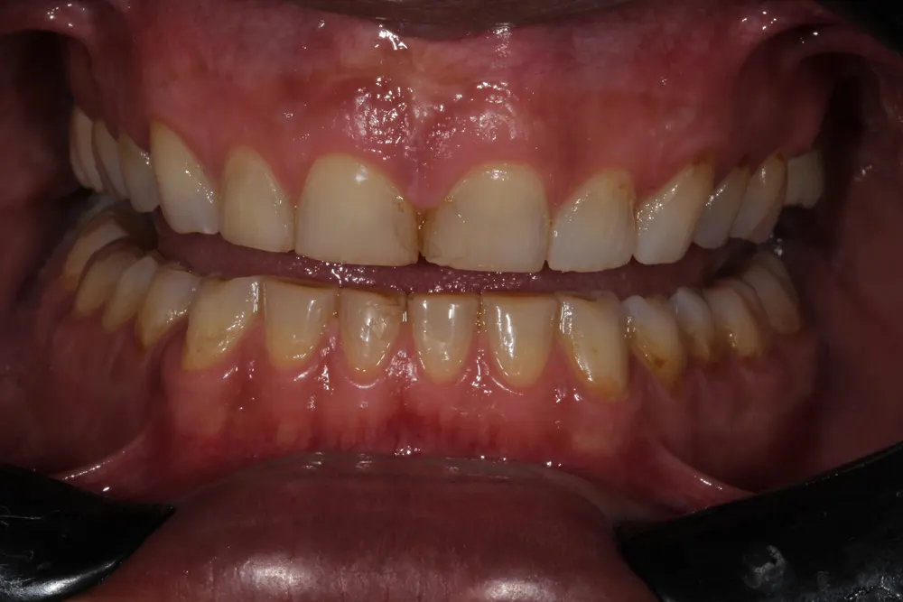 Frontal view: flat incisal edges on maxillary and mandibular incisors, with yellowish areas on the mandibular incisors.