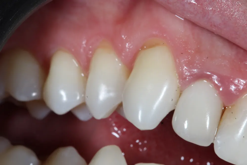 Lateral view of the maxillary canine and premolars, with gingival recession and an exposed root on the canine.