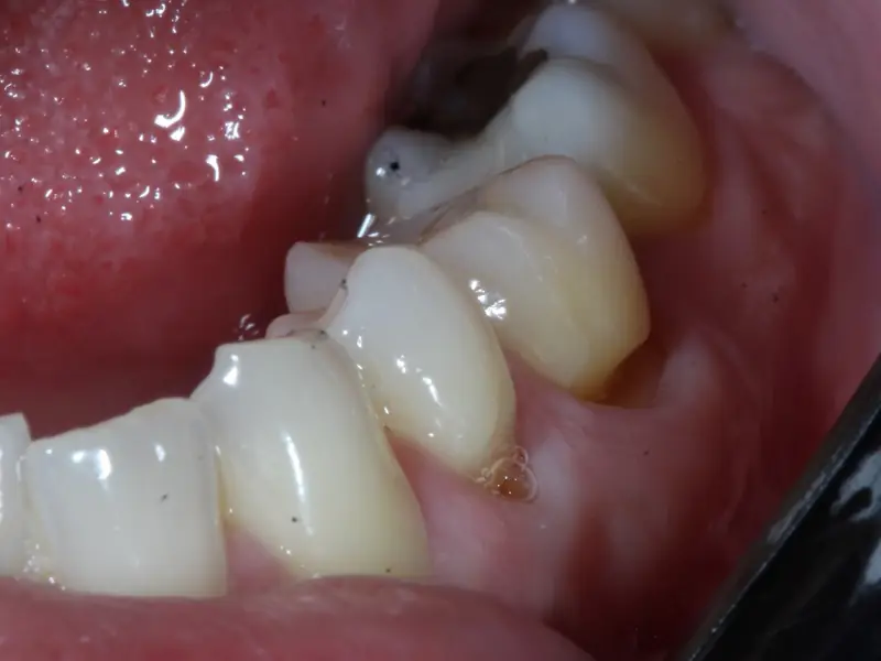Lateral view with a retractor, premolar and molar region, with tissue loss in the cervical area