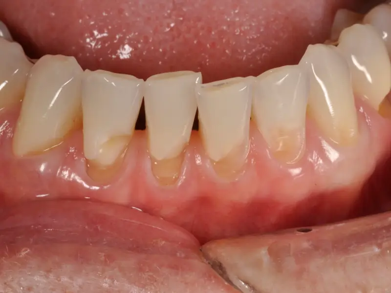 Lower anterior teeth held apart by a retractor, with cervical tissue loss and exposed dentin