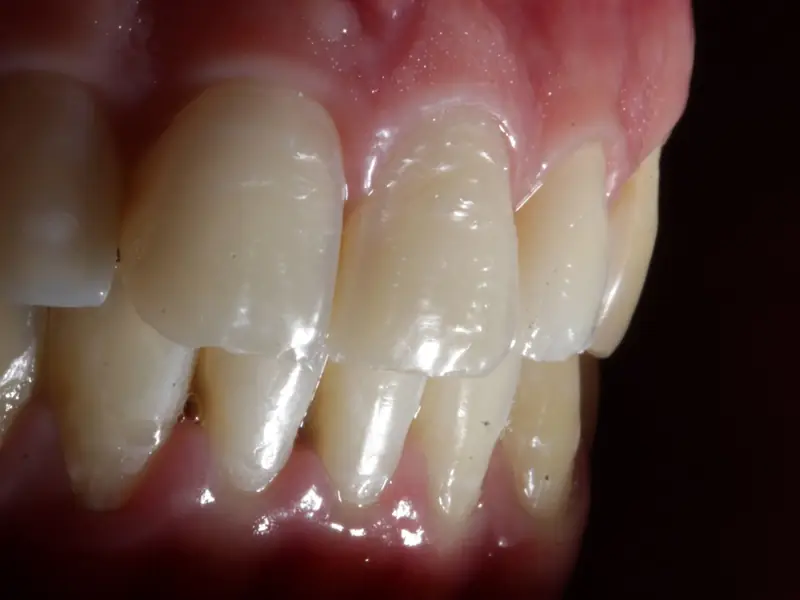 Lateral view, cervical third of the lower teeth with gingival recession and tissue loss at the margin