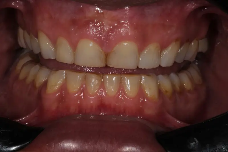 Front view with a retractor, the arches in contact, with wear on the incisal edges of the upper and lower teeth
